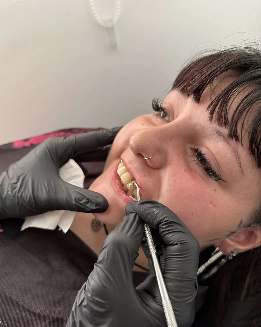 Gema dental colocada en el Curso de Gemas Dentales de la escuela ESAP de Madrid