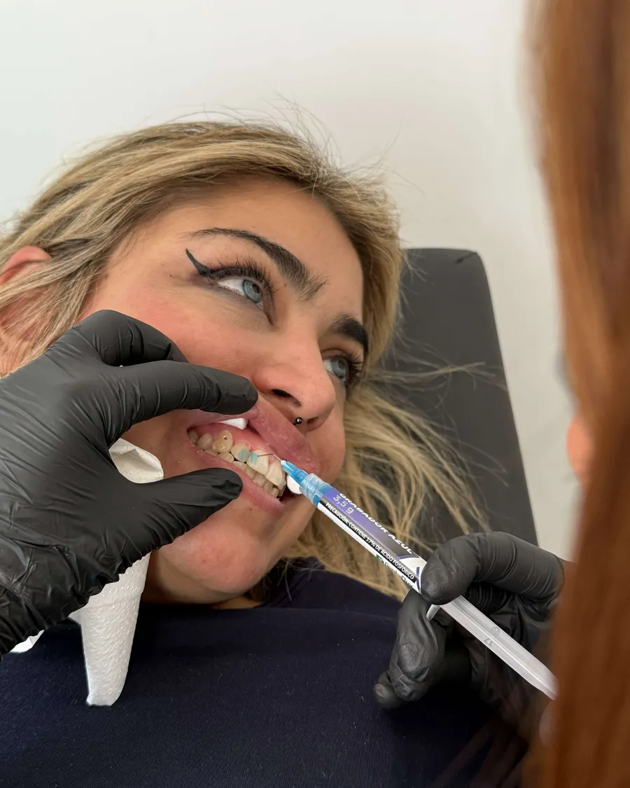 Colocación de una gema dental en el Curso de Gemas Dentales de la escuela ESAP de Madrid